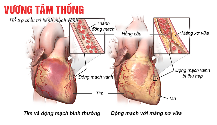 Những người bị đau thắt ngực không ổn định có nguy cơ cao bị nhồi máu cơ tim.png